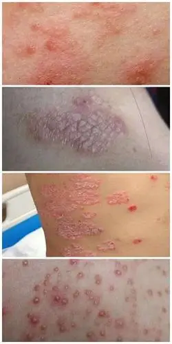 春节后看皮肤病出现热潮,过年期间的饮食极易引发皮肤病!