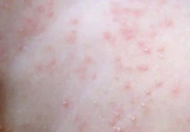 健康科普夏天常见皮肤病之痱子