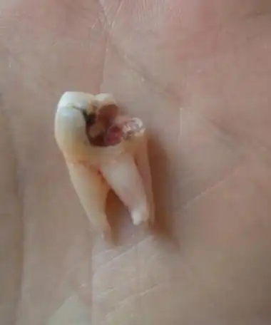 牙齿烂了一半是补还是拔掉?正确改善方案这里有!