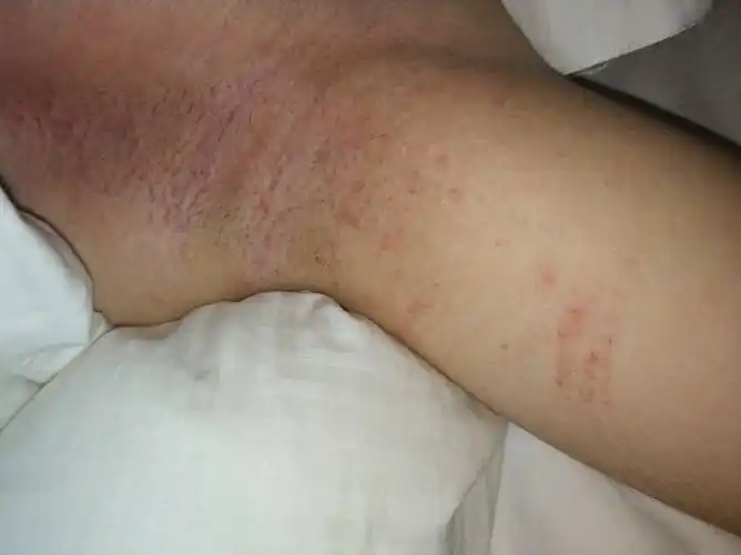 腋窝长满红色的痘痘,特别痒,怎么解决?