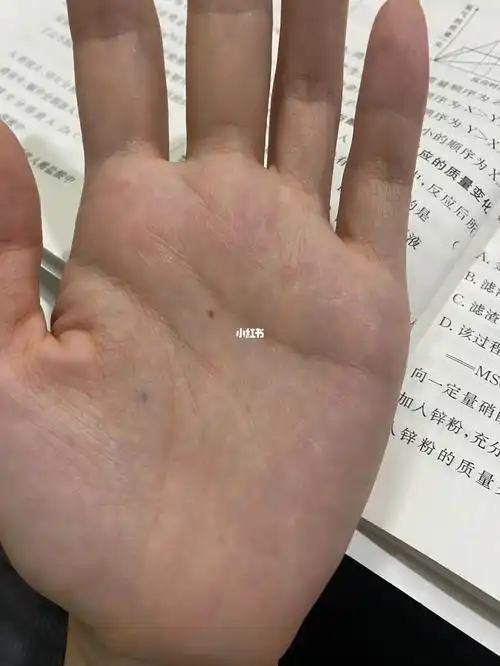 手心痣