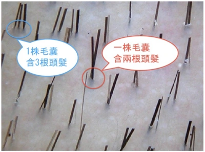 怎样判断自己的头发毛囊是否健康呢