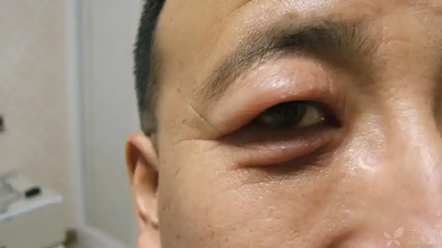 【眼眶病讨论】看看这个眼睑为什么反反复复水肿