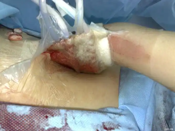 【 进展】vsd在全手脱套伤中的应用 [精华] [病例帖]