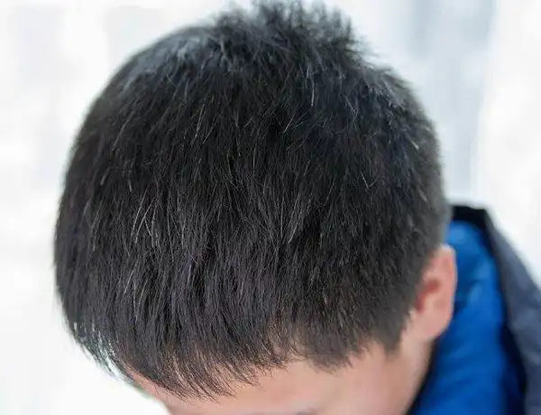 少年白头发应该如何调理方法少年白发的原因怎么治疗