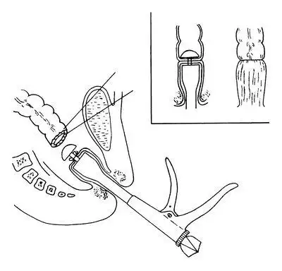 胃肠吻合器的常用术式