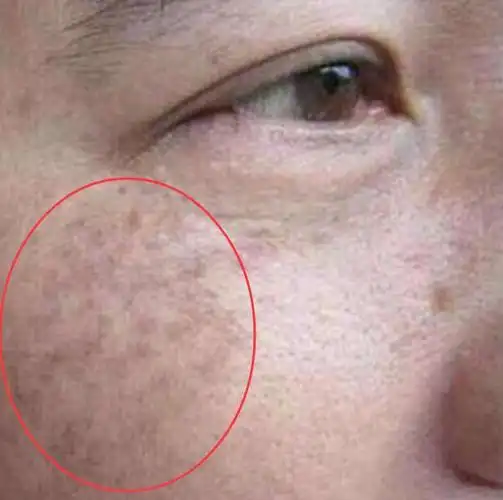 忠告:有以下5种习惯的女生,最容易长黄褐斑,2处方调理能祛斑
