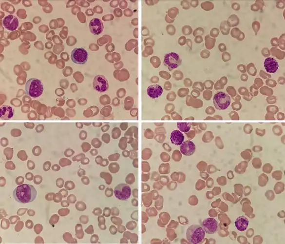 「流泪」的红细胞,你注意了吗?_医学界-助力医生临床决策和职业成长
