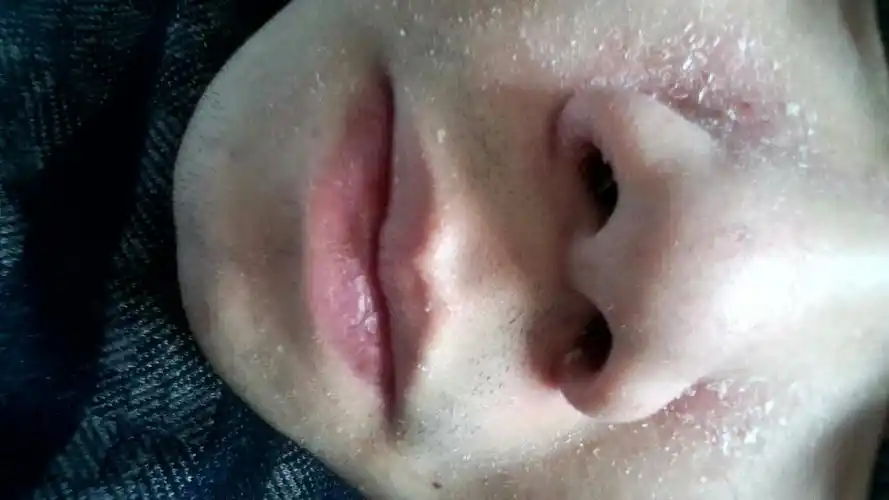 脸部旁边褪皮很严重,怎么办啊!