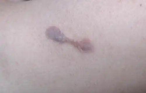 爸爸50多岁,最近身上长一些紫红色肉瘤,麻烦知道的给说下