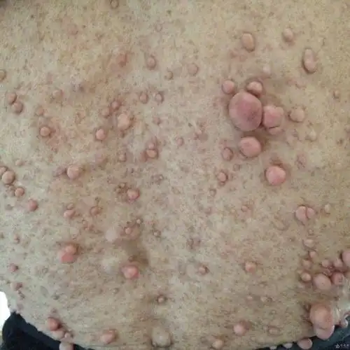 典型病例神经纤维瘤病