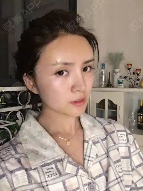 【自体脂肪填充全脸 术后第4天】