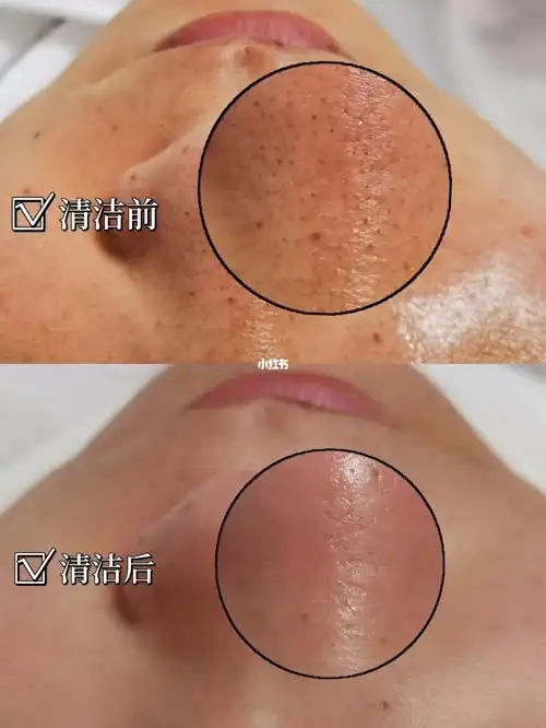毛孔深层清洁对比图