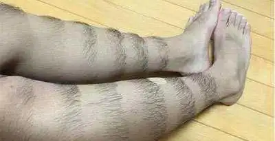 涨见识腿毛没用还挺丑医生告诉你腿毛反映的问题还挺多