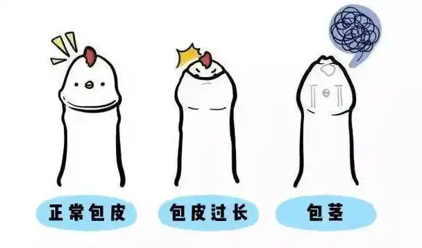 该怎么办?_手术_患者_龟头