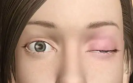 重症肌无力眼睑下垂的原因