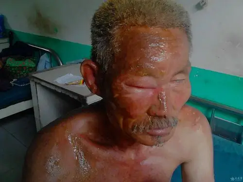 帮忙看看这个热油烫伤的病人!急!