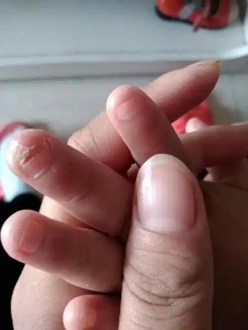 头条问答 - 5岁半的宝宝老是啃指甲,甚至把手指头都咬烂了,该怎么办?