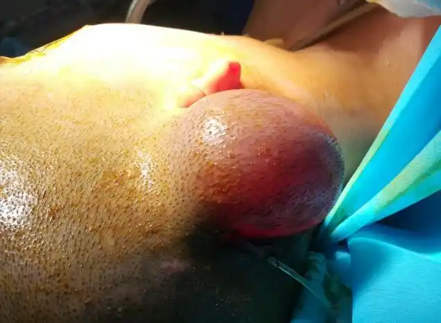 耳再造术后肿胀发紫正常吗