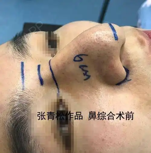 实例驼峰鼻矫正以及术后护理的注意事项