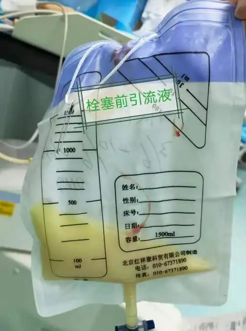 深圳首例!介入微创法成功治疗顽固性淋巴漏患者