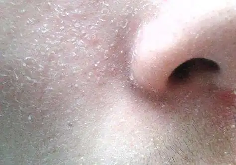 皮肤缺水一般有哪些表象秋冬皮肤干燥脱皮爆皮怎么办