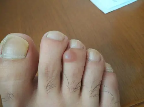 我的右脚中趾前段,最近长了一个硬疙瘩,按时有痛的感觉,曾经在