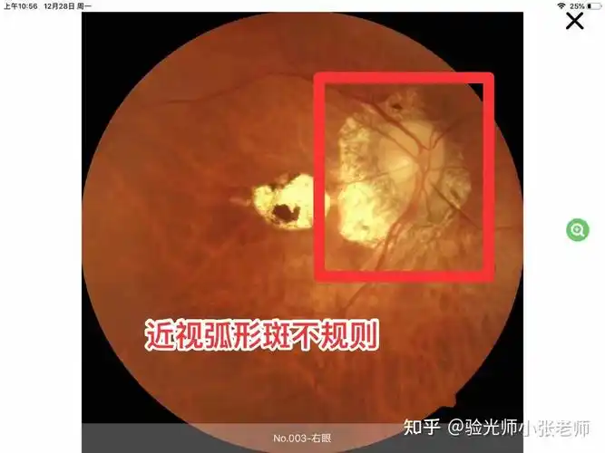 高度近视不可怕,可怕的是眼底病变