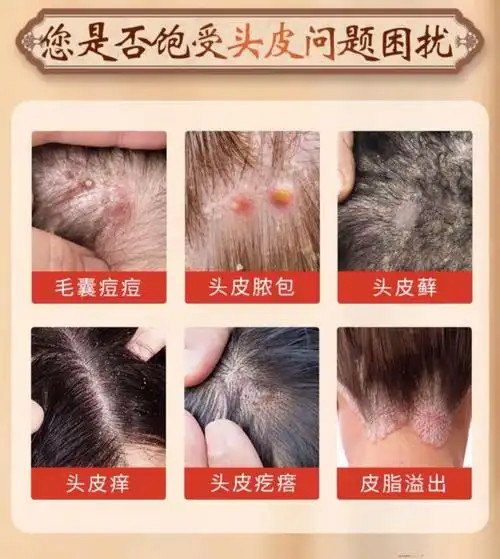 马拉色菌洗发水白云山毛囊焱炎控油洗发水去屑脓包螨虫疙瘩止痒露 一