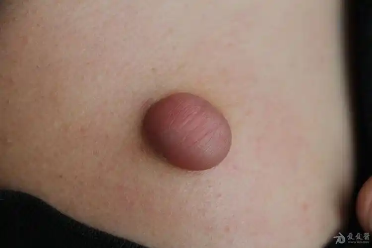 2015年皮肤版有奖病例猜答36答案钙化上皮瘤毛母质瘤3人回答准确已