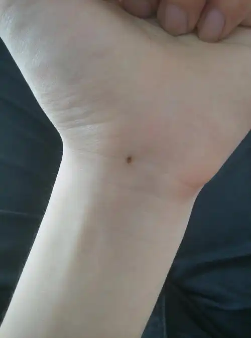 算命学中左手手腕有颗痣代表什么