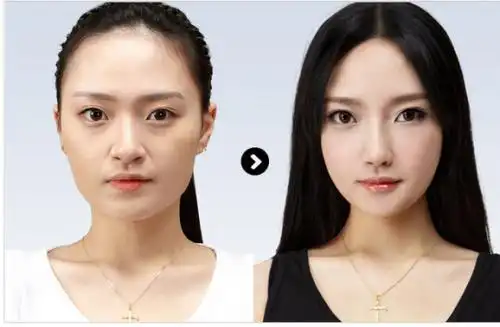 假体隆鼻整形前后对比(图)