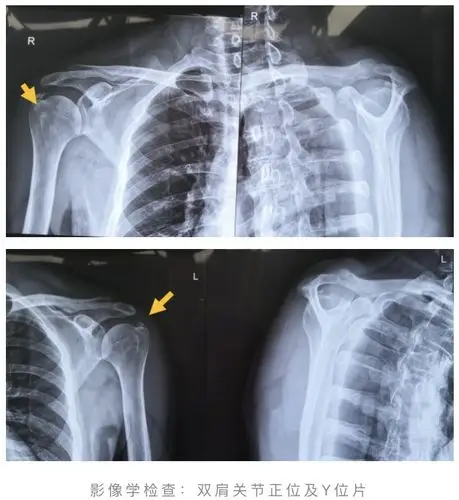 肌腱炎|钙化灶|肩关节_新浪新闻