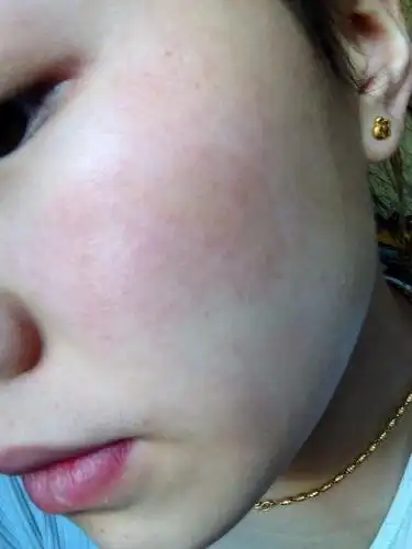 脸上的皮肤一个月前过敏,到现在都没有好