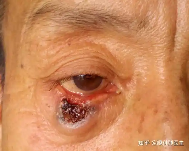最常见的眼睑恶性肿瘤