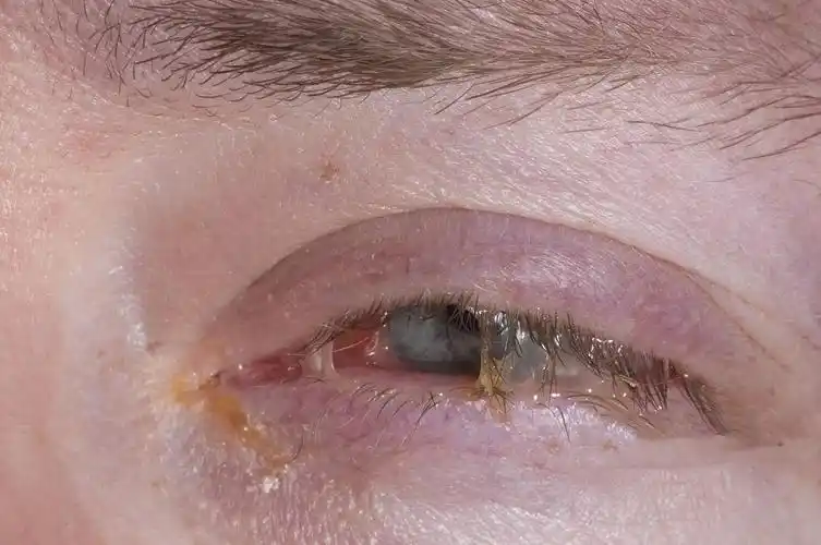 结膜炎常表现为患眼异物感,烧灼感,眼睑沉重,分泌物增多,当病变累及