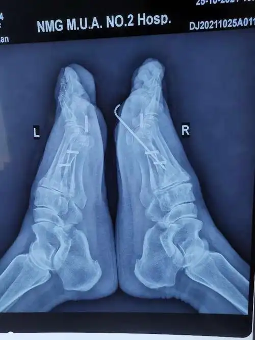 拇外翻大脚骨手术矫治术