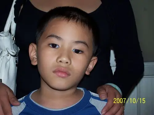 眼性斜颈(歪头)-上斜肌麻痹 - 好大夫在线