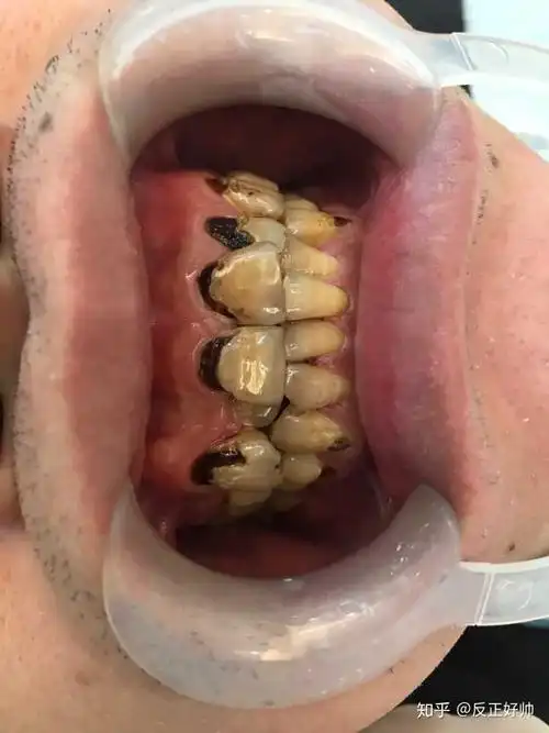 一口龋齿是什么样的体验?