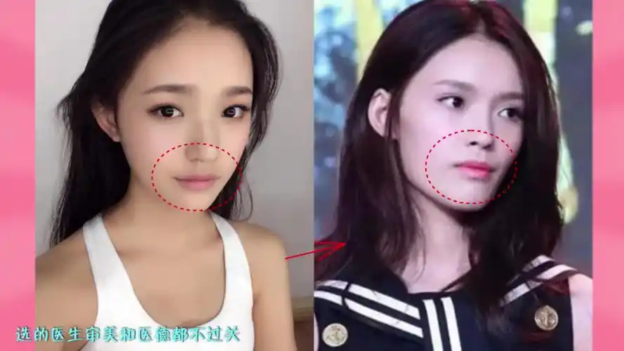 新氧明星整形教室:林允是怎么作死把初恋脸整成车座脸的?