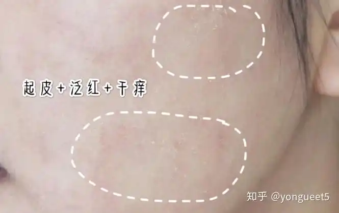 皮肤起皮泛红干痒美丽资产新肌修护精华油快速修复