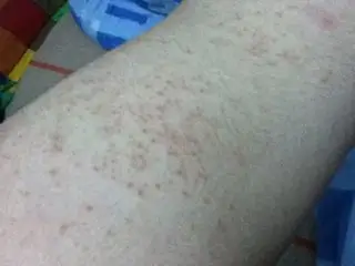 2014-02-16 唐荔霞 护师 前胸后背还有胳膊长痘痘,不知道是毛囊炎还是