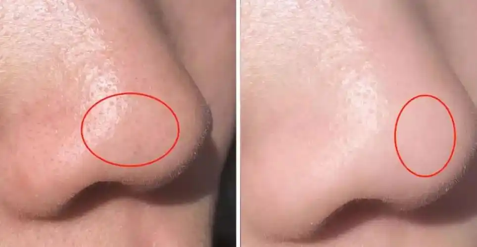 祛黑头不用那么麻烦喷一下就和毛孔污垢说再见