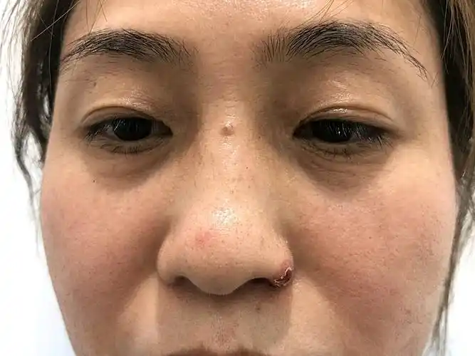 术前:我的皮肤状态一直不佳:毛孔粗大,暗沉发黄无光_圈子-新氧美容整