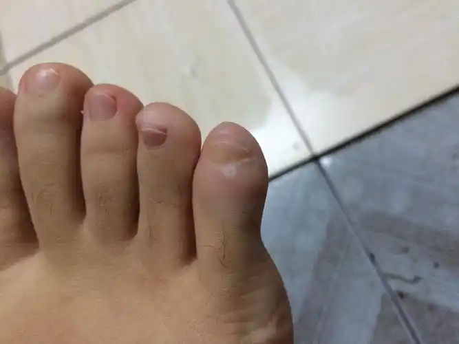 小脚趾长了个白色半透明的,像茧一样的东西,穿鞋子顶到很痛.