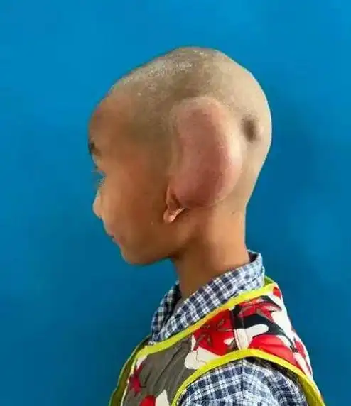 6岁男童小耳畸形,医生用它"雕"出新耳朵!