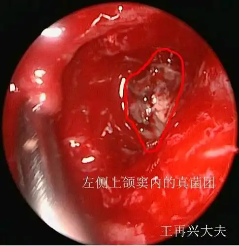 鼻科医生:鼻腔散发腥臭味,有6种原因,尤其要当心是恶性肿瘤4,鼻腔鼻窦