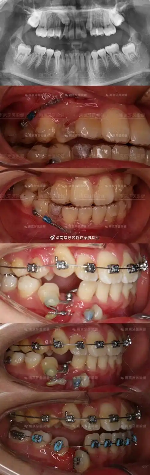 929292上颌尖牙是除第三磨牙外最易阻生的恒牙,患病率为1%-3%