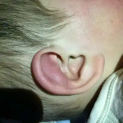 孩子不小心磕了一下,最近发现耳朵肿大了,不知道怎麼回事,麻烦大家