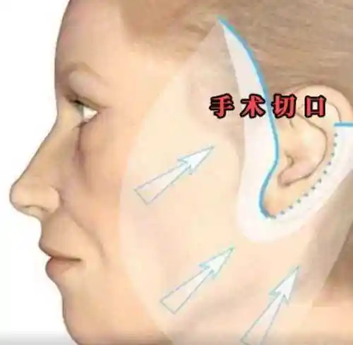 小切口拉皮手术可以维持多久?